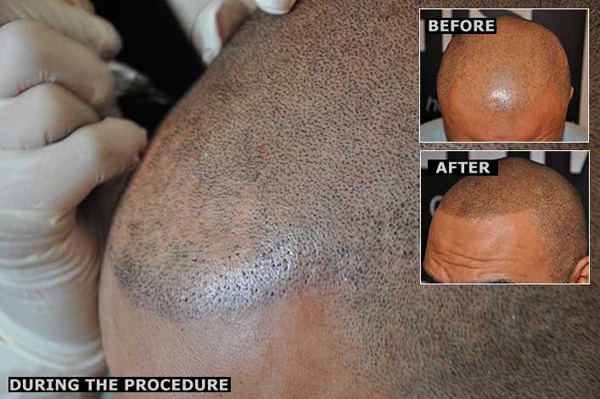 Realistic Hair Tattoos Eliminate Baldness Forever