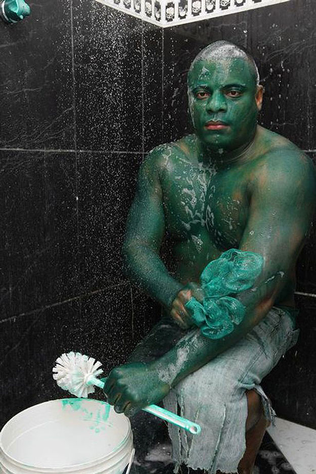 The Man Who Got Green Hulk Skin (Kids, Don’t Try This At Home)