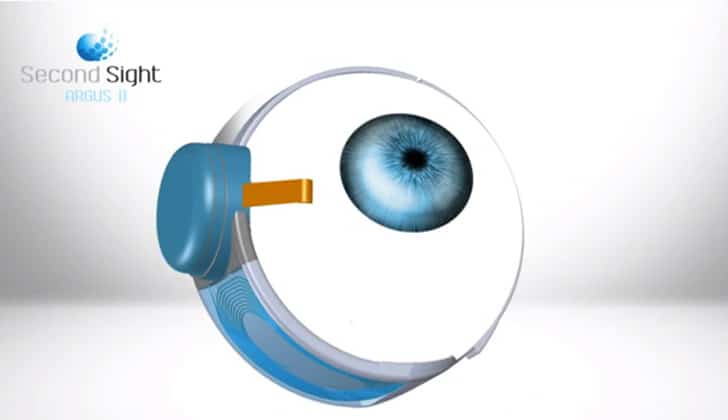 World’s First Bionic Eye: Most Sophisticated Prosthetic Ever Developed