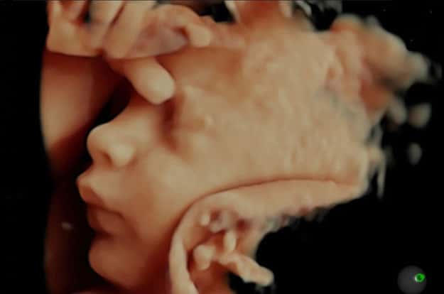 3D Ultrasound Imaging Creates 3D Color Photo Of Your Unborn Baby